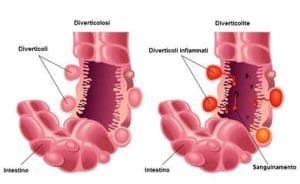 Urologo può aiutarti. Fai una visita urologica per curare diverticoli infiammati