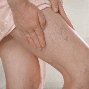 dolore gambe insufficienza venosa