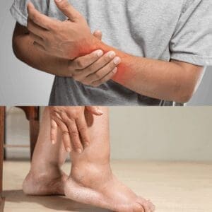 artrite rumatoide sintomi